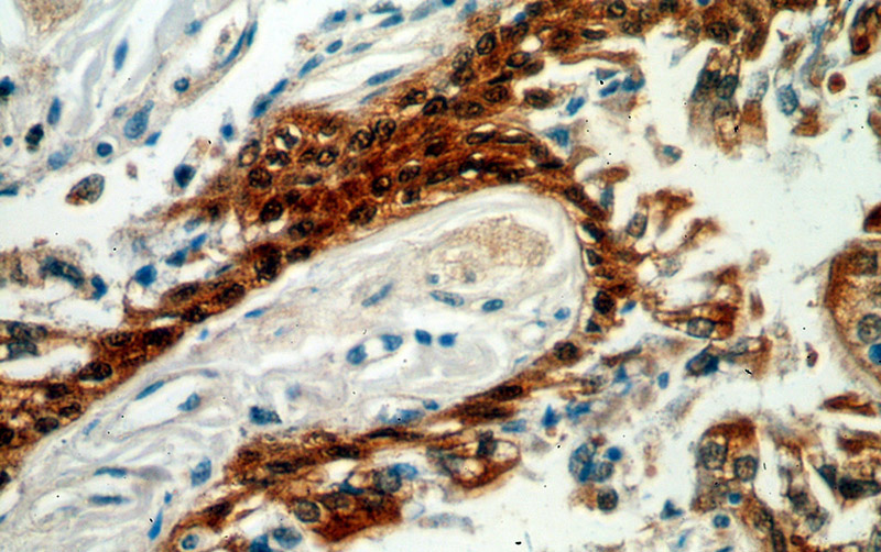 Immunohistochemical of paraffin-embedded human lung cancer using Catalog No:111699(HSPA6 antibody) at dilution of 1:50 (under 40x lens)