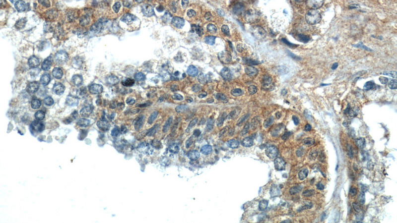 Immunohistochemistry of paraffin-embedded human prostate hyperplasia tissue slide using Catalog No:112421(LZTS2 Antibody) at dilution of 1:50 (under 40x lens)