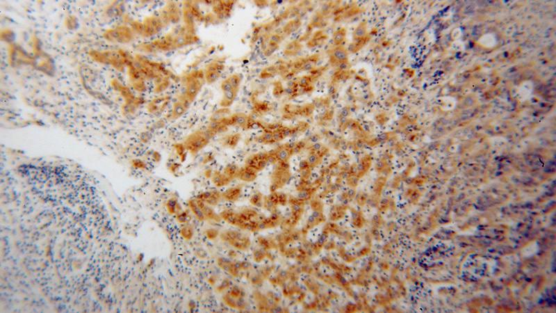 Immunohistochemical of paraffin-embedded human liver cancer using Catalog No:113822(PHKG2 antibody) at dilution of 1:100 (under 10x lens)