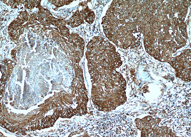 Immunohistochemical of paraffin-embedded human lung cancer using Catalog No:115731(STOML2 antibody) at dilution of 1:100 (under 10x lens)