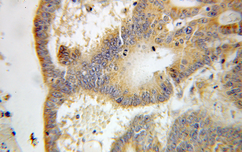 Immunohistochemical of paraffin-embedded human colon cancer using Catalog No:110387(EPHX2 antibody) at dilution of 1:100 (under 10x lens)