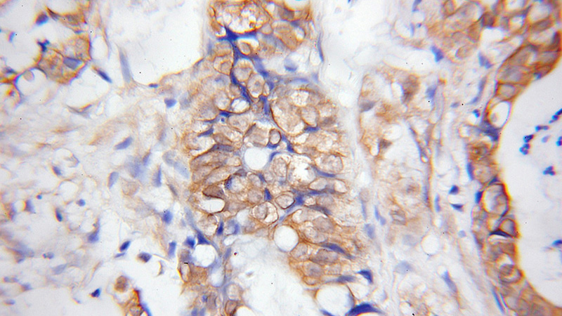 Immunohistochemical of paraffin-embedded human pancreas cancer using Catalog No:110062(DPEP1 antibody) at dilution of 1:50 (under 10x lens)