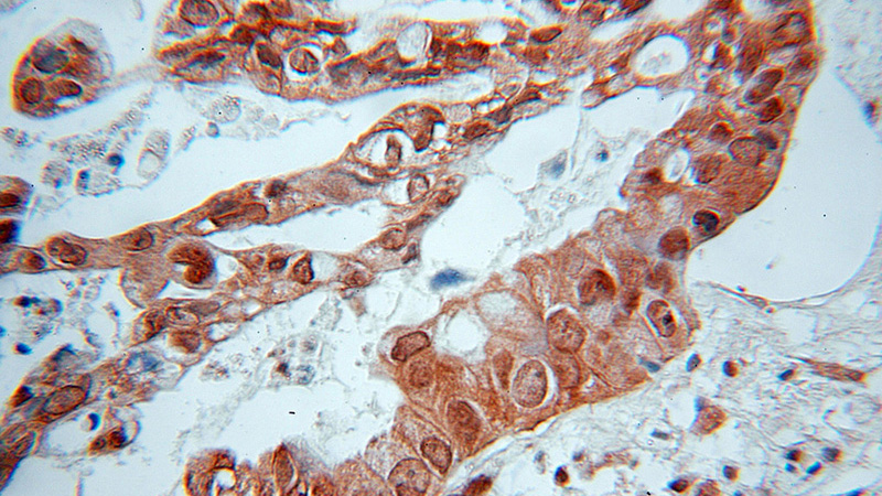 Immunohistochemical of paraffin-embedded human pancreas cancer using Catalog No:114697(RIC8A antibody) at dilution of 1:50 (under 10x lens)