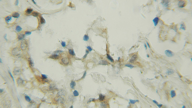Immunohistochemical of paraffin-embedded human prostate cancer using Catalog No:113671(PDE9A antibody) at dilution of 1:50 (under 10x lens)