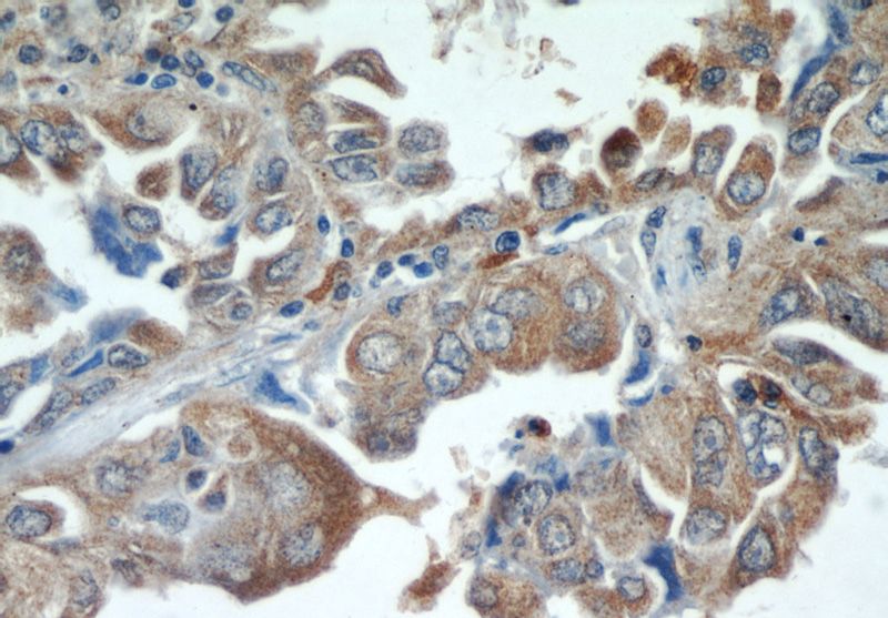 Immunohistochemical of paraffin-embedded human lung cancer using Catalog No:113871(PIK3CA antibody) at dilution of 1:50 (under 40x lens)