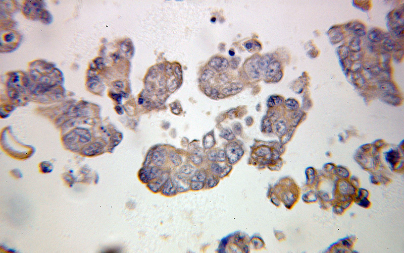 Immunohistochemical of paraffin-embedded human ovary tumor using Catalog No:113633(PDLIM7,LMP1 antibody) at dilution of 1:100 (under 25x lens)