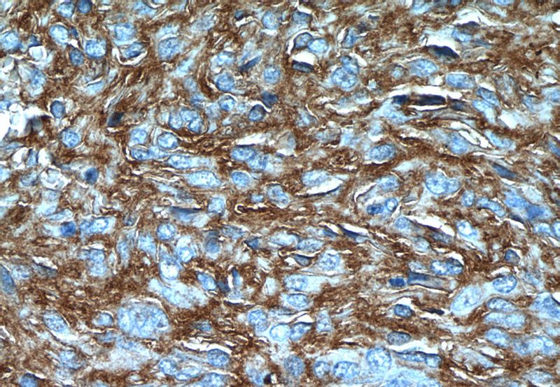 Immunohistochemistry of paraffin-embedded stromal tumor tissue slide using Catalog No:116104(ANO1,DOG1 Antibody) at dilution of 1:50 (under 40x lens)