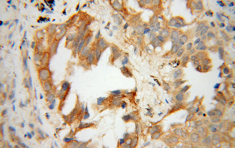 Immunohistochemical of paraffin-embedded human lung cancer using Catalog No:112529(MFN1 antibody) at dilution of 1:100 (under 40x lens)