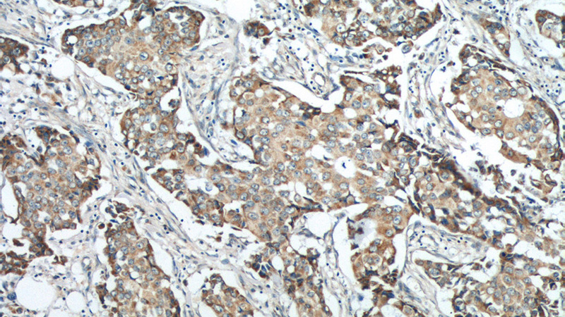 Immunohistochemistry of paraffin-embedded human breast cancer tissue slide using Catalog No:112612(MICB Antibody) at dilution of 1:50 (under 10x lens)