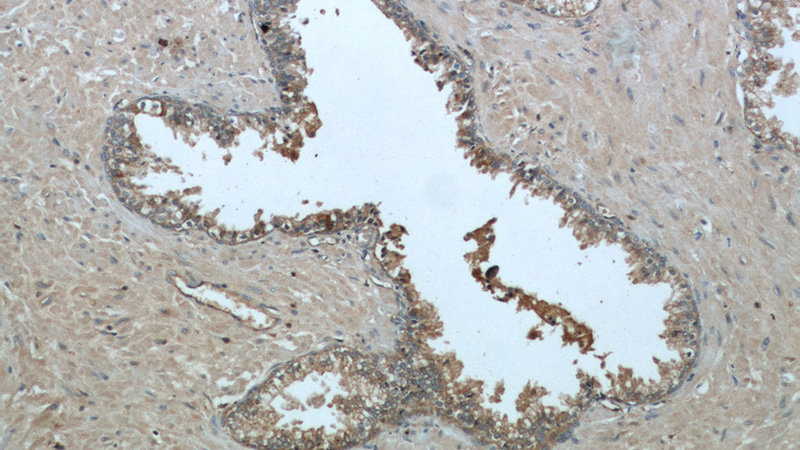 Immunohistochemistry of paraffin-embedded human prostate cancer tissue slide using Catalog No:107076 (B2M Antibody) at dilution of 1:200 (under 10x lens)