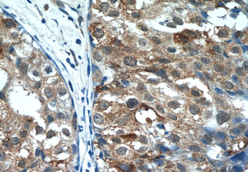Immunohistochemistry of paraffin-embedded human breast cancer tissue slide using Catalog No:109252(CENPF Antibody) at dilution of 1:50 (under 40x lens)
