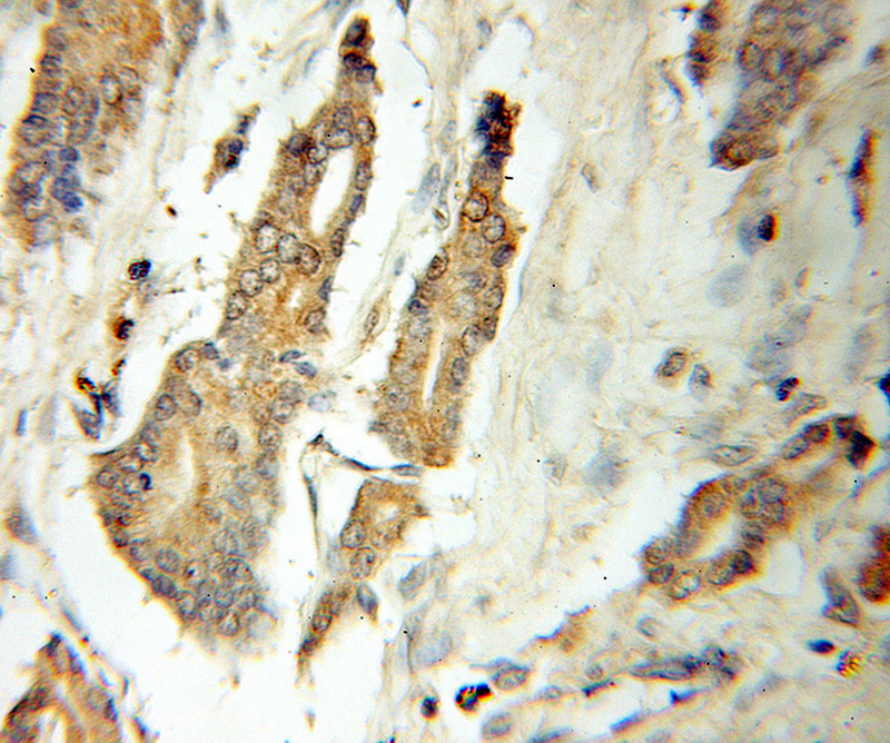 Immunohistochemical of paraffin-embedded human prostate cancer using Catalog No:108288(ATG12 antibody) at dilution of 1:50 (under 10x lens)