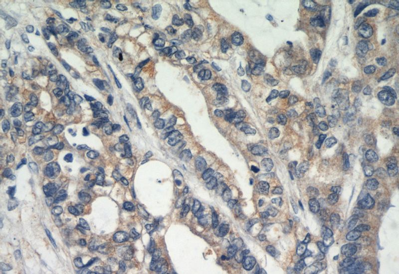 Immunohistochemical of paraffin-embedded human colon cancer using Catalog No:110289(CDH1-Specific antibody) at dilution of 1:50 (under 40x lens)