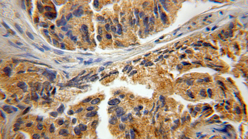 Immunohistochemical of paraffin-embedded human prostate cancer using Catalog No:109516(CPNE3 antibody) at dilution of 1:50 (under 10x lens)