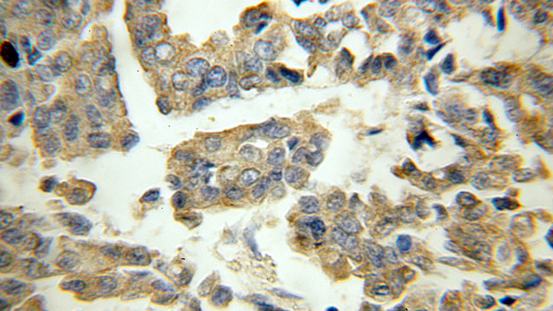 Immunohistochemical of paraffin-embedded human breast cancer using Catalog No:114585(RB1CC1 antibody) at dilution of 1:200 (under 40x lens)
