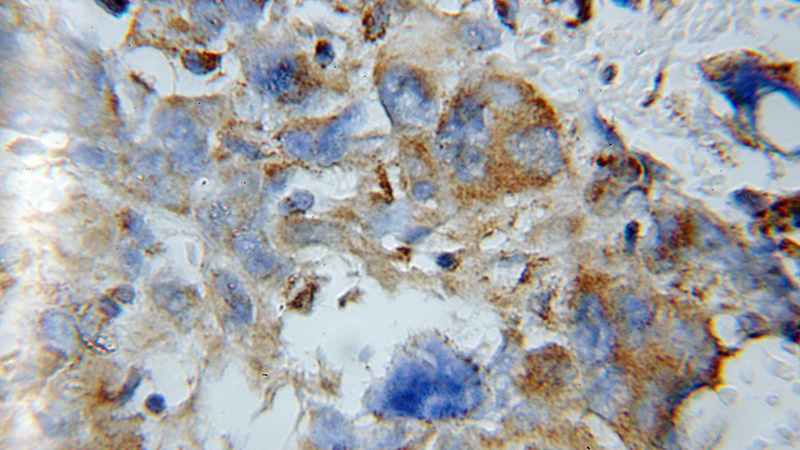 Immunohistochemical of paraffin-embedded human gliomas using Catalog No:109491(COX5A antibody) at dilution of 1:50 (under 10x lens)