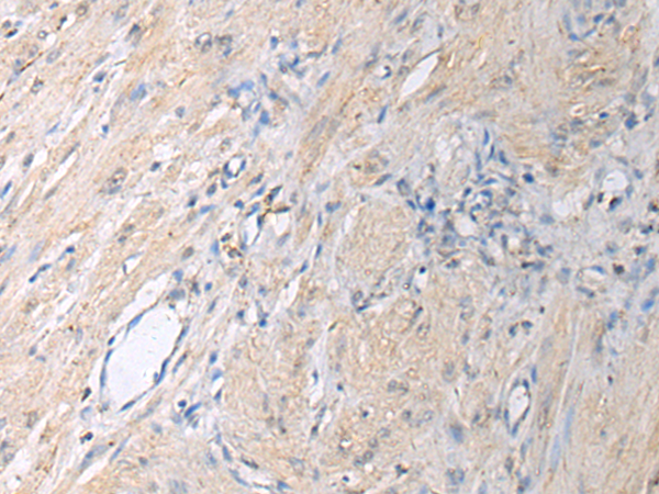 Immunohistochemistry analysis of paraffin-embedded Human gastric cancer using GNAI1 antibody. High-pressure and temperature Sodium Citrate pH 6.0 was used for antigen retrieval.