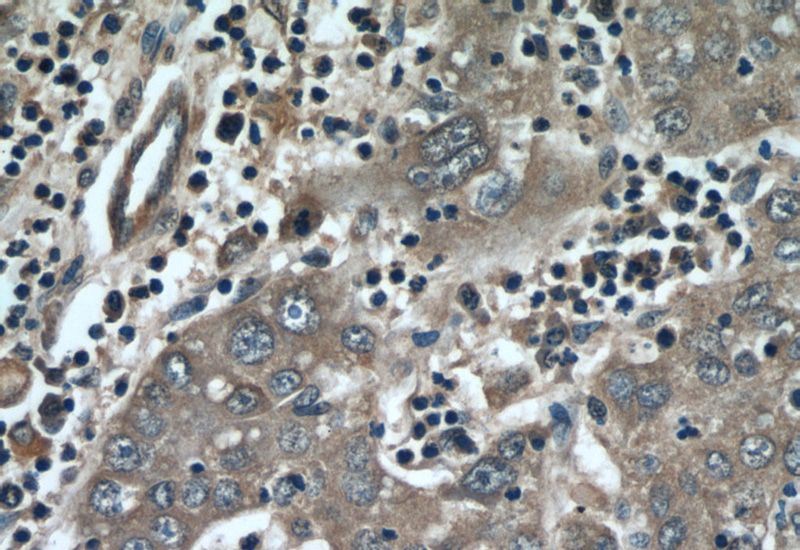 Immunohistochemical of paraffin-embedded human liver cancer using Catalog No:112701(MMP20 antibody) at dilution of 1:50 (under 40x lens)