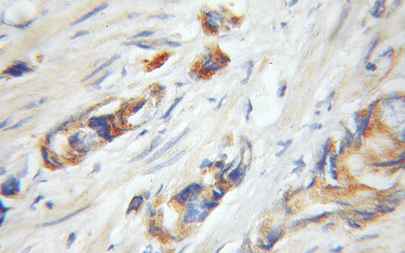 Immunohistochemical of paraffin-embedded human prostate cancer using Catalog No:116562(UHMK1 antibody) at dilution of 1:50 (under 10x lens)