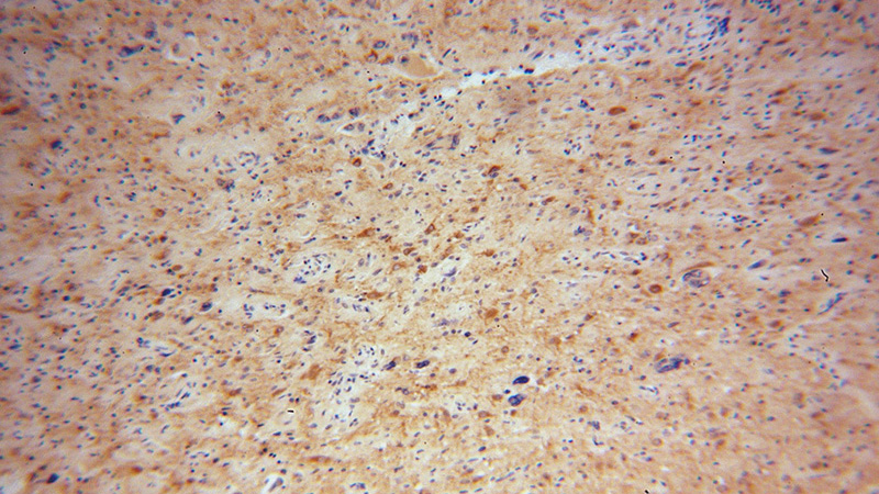 Immunohistochemical of paraffin-embedded human gliomas using Catalog No:110135(DYNC1I1 antibody) at dilution of 1:50 (under 10x lens)