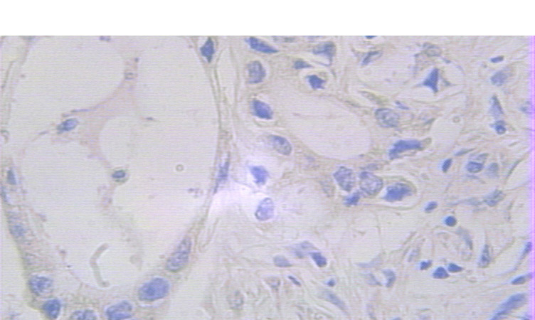 Immunohistochemical of paraffin-embedded human pancreas cancer using Catalog No:110468(FAM127A antibody) at dilution of 1:100 (under 25x lens)