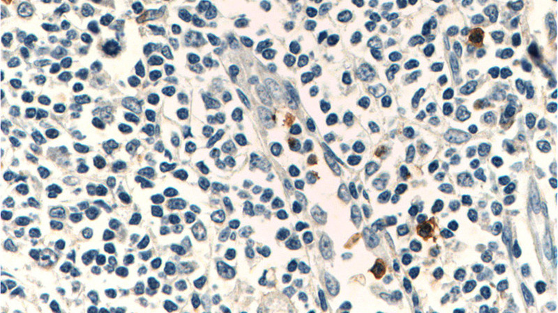 Immunohistochemistry of paraffin-embedded human tonsillitis tissue slide using Catalog No:109076(CCR3 Antibody) at dilution of 1:200 (under 40x lens)