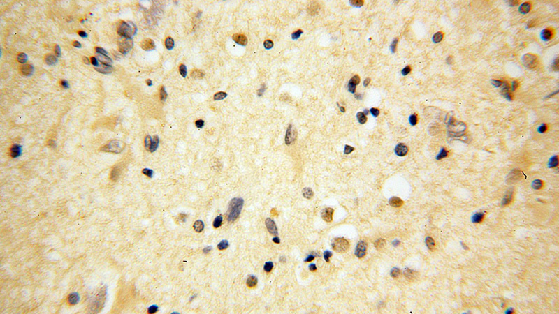 Immunohistochemical of paraffin-embedded human gliomas using Catalog No:117246(BRUNOL5 antibody) at dilution of 1:50 (under 40x lens)