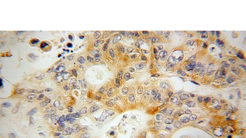 Immunohistochemical of paraffin-embedded human colon cancer using Catalog No:111920(KBTBD2 antibody) at dilution of 1:50 (under 40x lens)