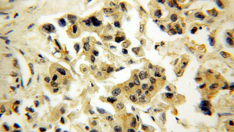 Immunohistochemical of paraffin-embedded human breast cancer using Catalog No:114149(PPP1R13L antibody) at dilution of 1:100 (under 40x lens)