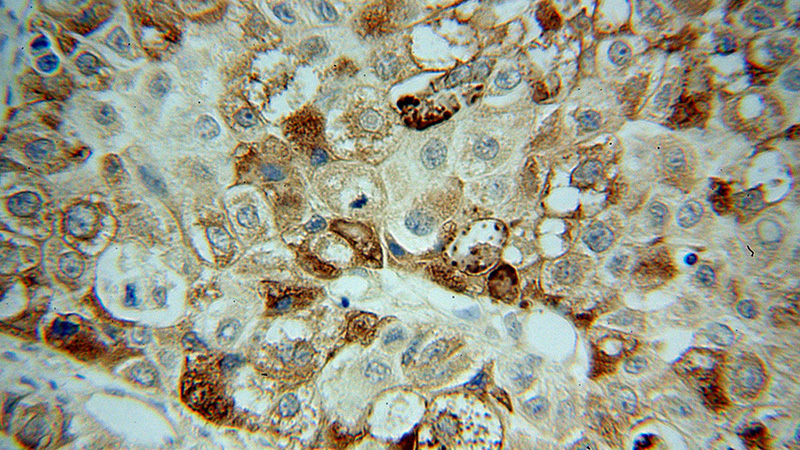 Immunohistochemical of paraffin-embedded human liver cancer using Catalog No:109073(CCPG1 antibody) at dilution of 1:50 (under 40x lens)