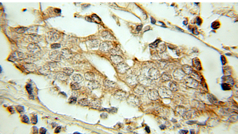 Immunohistochemical of paraffin-embedded human prostate cancer using Catalog No:114251(PSMG2 antibody) at dilution of 1:50 (under 10x lens)
