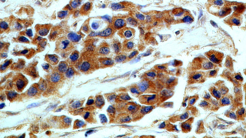 Immunohistochemical of paraffin-embedded human breast cancer using Catalog No:115280(PTPN11 antibody) at dilution of 1:100 (under 40x lens)