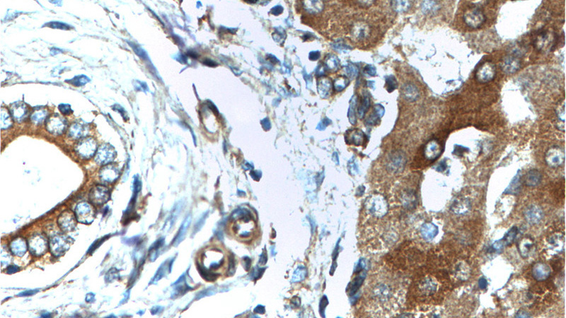 Immunohistochemistry of paraffin-embedded human liver tissue slide using Catalog No:110764(G6PC Antibody) at dilution of 1:200 (under 40x lens).