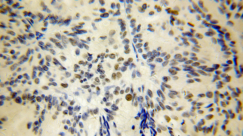 Immunohistochemical of paraffin-embedded human ovary tumor using Catalog No:113815(PHF6 antibody) at dilution of 1:50 (under 40x lens)