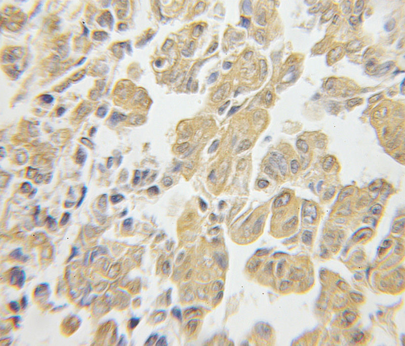 Immunohistochemical of paraffin-embedded human ovary tumor using Catalog No:114843(RPS3 antibody) at dilution of 1:50 (under 10x lens)