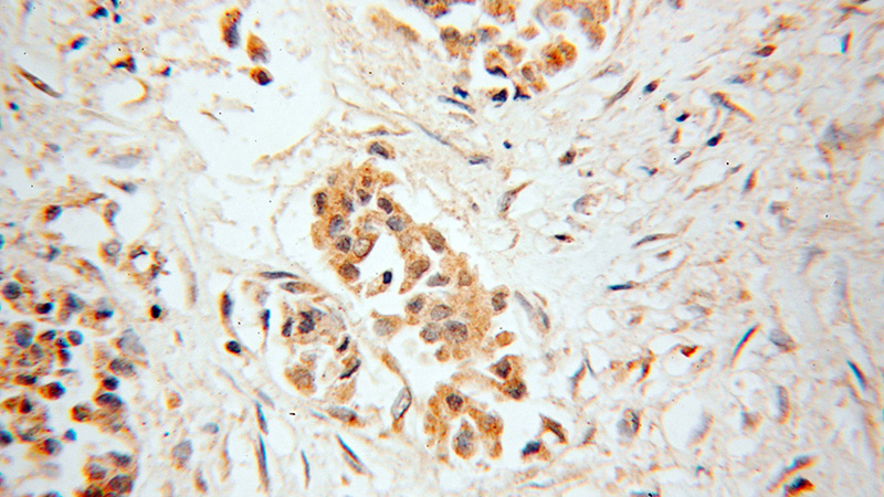 Immunohistochemical of paraffin-embedded human breast cancer using Catalog No:112837(MRPL9 antibody) at dilution of 1:100 (under 40x lens)