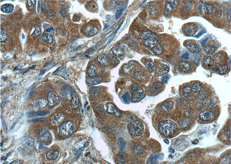 Immunohistochemistry of paraffin-embedded human lung cancer tissue slide using Catalog No:114921(RRAS2 Antibody) at dilution of 1:50 (under 40x lens)
