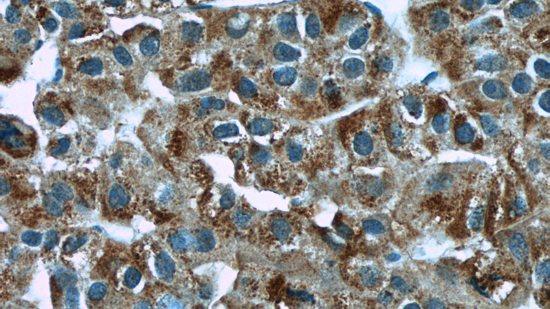 Immunohistochemistry of paraffin-embedded human liver cancer slide using Catalog No:112921(C19orf10 Antibody) at dilution of 1:50