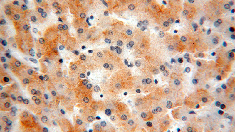 Immunohistochemical of paraffin-embedded human liver cancer using Catalog No:114901(RPL7L1 antibody) at dilution of 1:200 (under 40x lens)