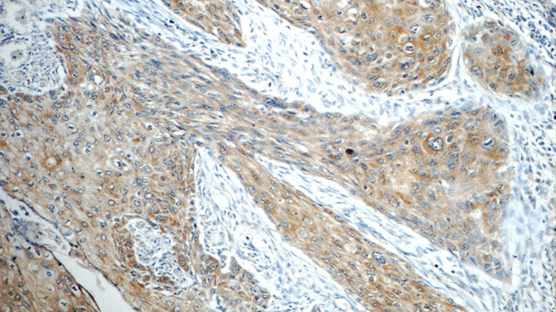 Immunohistochemistry of paraffin-embedded human oesophagus cancer tissue slide using Catalog No:112408(LYNX1 Antibody) at dilution of 1:50 (under 10x lens)