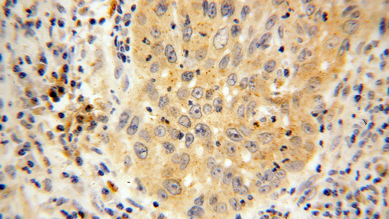 Immunohistochemical of paraffin-embedded human cervical cancer using Catalog No:109370(COG7 antibody) at dilution of 1:100 (under 40x lens)