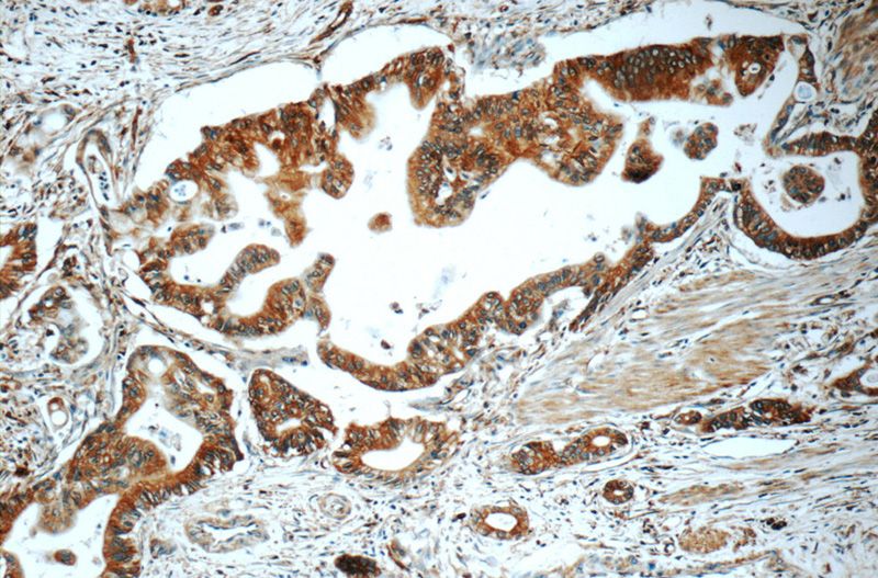Immunohistochemistry of paraffin-embedded human pancreas cancer tissue slide using Catalog No:115850(TAP1 Antibody) at dilution of 1:50 (under 10x lens)