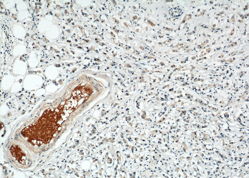 Immunohistochemical of paraffin-embedded human breast cancer using Catalog No:115824(SULF2 antibody) at dilution of 1:50 (under 10x lens)