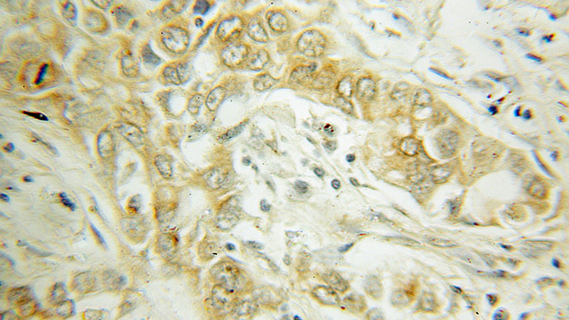 Immunohistochemical of paraffin-embedded human lung cancer using Catalog No:107801(ABCD1 antibody) at dilution of 1:50 (under 10x lens)