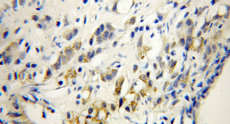 Immunohistochemical of paraffin-embedded human prostate cancer using Catalog No:116972(WSB2 antibody) at dilution of 1:50 (under 40x lens)