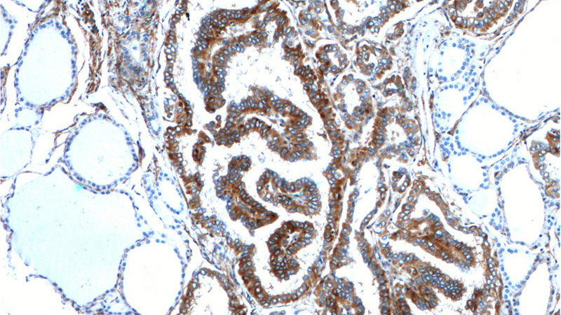 Immunohistochemistry of paraffin-embedded human thyroid cancer tissue slide using Catalog No:113846(PRKCA Antibody) at dilution of 1:200 (under 10x lens).