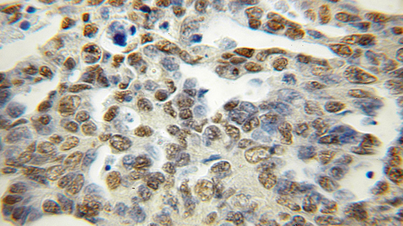 Immunohistochemical of paraffin-embedded human ovary tumor using Catalog No:113757(PCTP antibody) at dilution of 1:50 (under 10x lens)