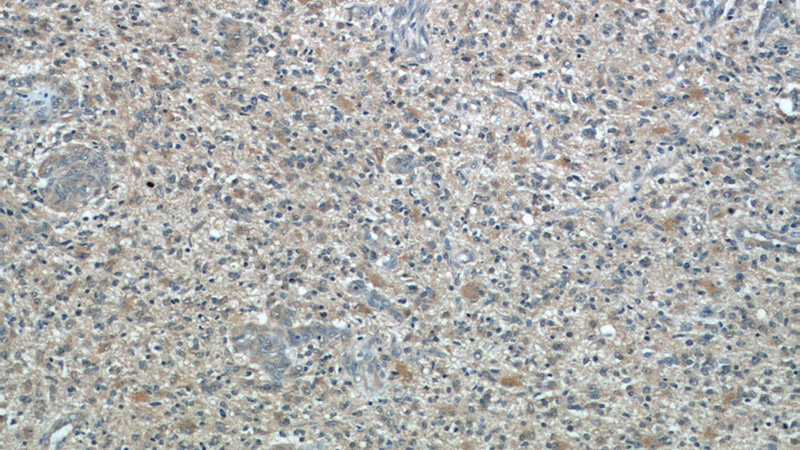 Immunohistochemical of paraffin-embedded human gliomas using Catalog No:116243(TOMM7 antibody) at dilution of 1:50 (under 10x lens)