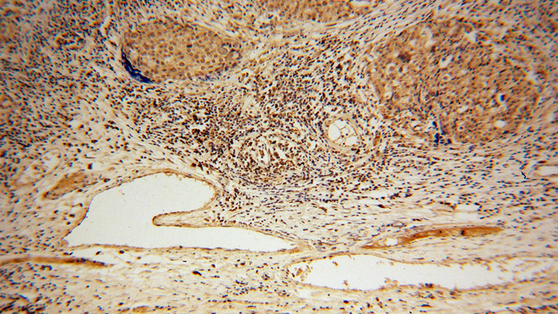 Immunohistochemical of paraffin-embedded human ovary tumor using Catalog No:113003(MYST2 antibody) at dilution of 1:50 (under 10x lens)