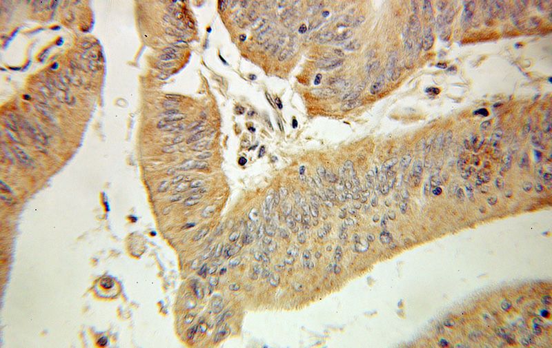 Immunohistochemical of paraffin-embedded human colon cancer using Catalog No:116547(UCP3 antibody) at dilution of 1:100 (under 10x lens)